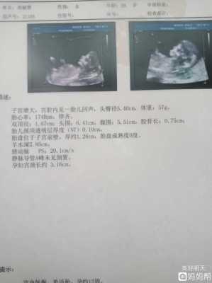 12周胎儿图(孕妇怀孕到12周胎心160正常吗) 第2张 12周胎儿图(孕妇怀孕到12周胎心160正常吗) 第2张