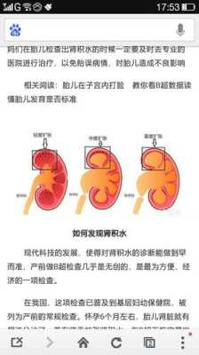 胎儿右肾轻度积水(胎儿右肾轻度积水是什么意思) 第1张 胎儿右肾轻度积水(胎儿右肾轻度积水是什么意思) 第1张