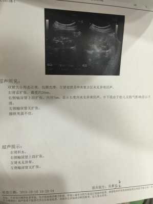胎儿右肾轻度积水(胎儿右肾轻度积水是什么意思) 第2张 胎儿右肾轻度积水(胎儿右肾轻度积水是什么意思) 第2张