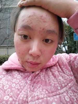孕期满脸痘痘怎么办(孕期满脸痘痘怎么办啊) 第2张 孕期满脸痘痘怎么办(孕期满脸痘痘怎么办啊) 第2张