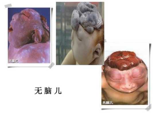 胎儿无脑(胎儿无脑儿是什么原因造成的) 第1张 胎儿无脑(胎儿无脑儿是什么原因造成的) 第1张