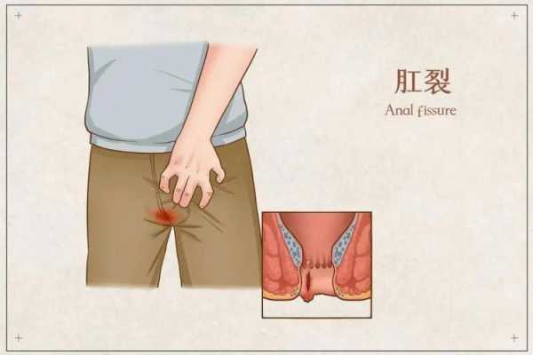 孕期肛门痛(孕期肛门痛什么原因引起的) 第2张 孕期肛门痛(孕期肛门痛什么原因引起的) 第2张