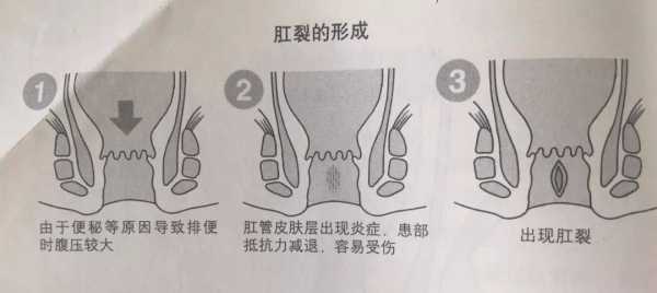 孕期肛门痛(孕期肛门痛什么原因引起的) 第1张 孕期肛门痛(孕期肛门痛什么原因引起的) 第1张