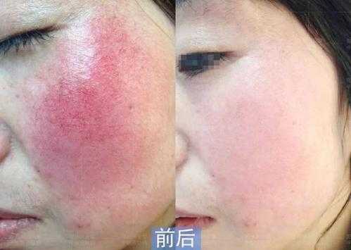 怀孕四个月了流一点血丝是怎么回事,孕期红血丝分泌 第1张 怀孕四个月了流一点血丝是怎么回事,孕期红血丝分泌 第1张