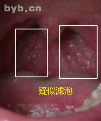 咽炎对胎儿有影响吗(孕妇咽炎对胎儿有影响吗) 第2张 咽炎对胎儿有影响吗(孕妇咽炎对胎儿有影响吗) 第2张