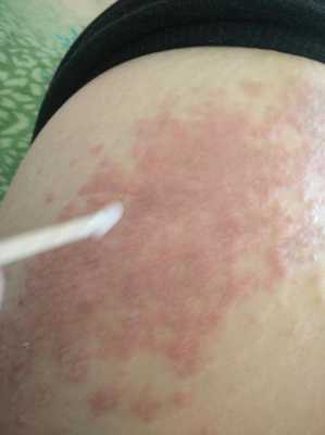 怀孕期间湿疹怎么办(孕妇得湿疹怎么治) 第3张 怀孕期间湿疹怎么办(孕妇得湿疹怎么治) 第3张