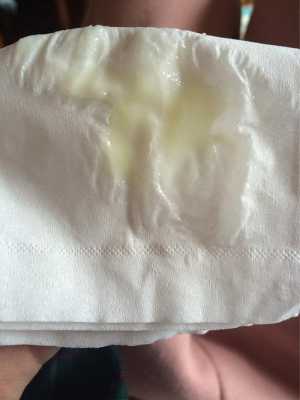 孕期霉菌是什么症状(孕妇白带检查霉菌为阳性有问题吗) 第2张 孕期霉菌是什么症状(孕妇白带检查霉菌为阳性有问题吗) 第2张