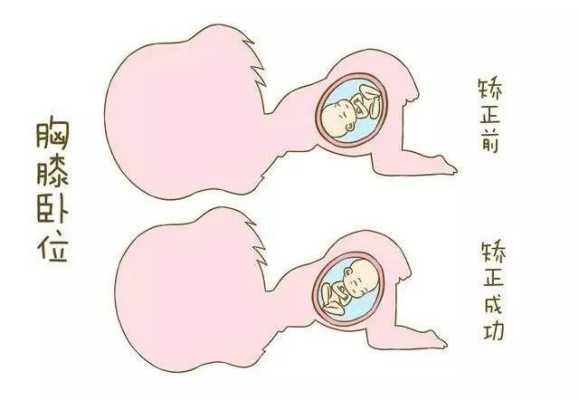 胎儿转位(胎儿转位有什么感觉) 第2张 胎儿转位(胎儿转位有什么感觉) 第2张
