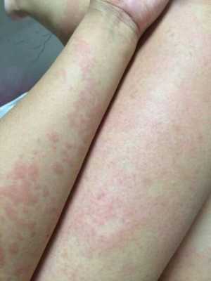 怀孕了皮肤过敏很痒怎么办,怀孕期间过敏了怎么办啊  第2张