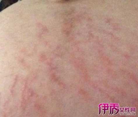 怀孕了皮肤过敏很痒怎么办,怀孕期间过敏了怎么办啊  第3张