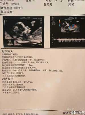 怀孕12周nt12胎儿颈部水囊瘤水肿怎么办,胎儿为什么会水肿和水囊瘤 第2张 怀孕12周nt12胎儿颈部水囊瘤水肿怎么办,胎儿为什么会水肿和水囊瘤 第2张