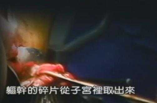 胎儿多大能做人流(胎儿多大能做人流手术) 第2张 胎儿多大能做人流(胎儿多大能做人流手术) 第2张