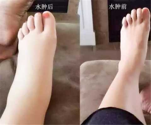 孕期腿水肿(怀孕期间的孕妇腿肿是怎么回事) 第1张 孕期腿水肿(怀孕期间的孕妇腿肿是怎么回事) 第1张