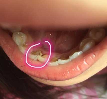 孕期牙齿坏了怎么办,孕期牙齿掉了一小块是缺钙吗 第2张 孕期牙齿坏了怎么办,孕期牙齿掉了一小块是缺钙吗 第2张