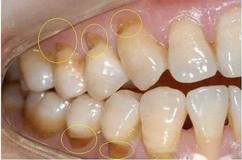 孕期牙齿坏了怎么办,孕期牙齿掉了一小块是缺钙吗 第1张 孕期牙齿坏了怎么办,孕期牙齿掉了一小块是缺钙吗 第1张
