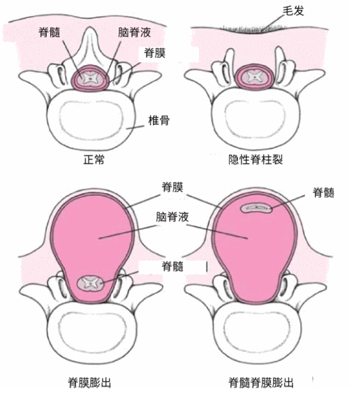 什么是胎儿脊柱裂,孕期脊柱疼怎么回事  第3张
