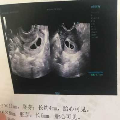 胎囊和胎儿(孕囊就是宝宝吗) 第2张 胎囊和胎儿(孕囊就是宝宝吗) 第2张