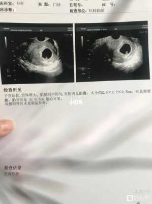胎囊和胎儿(孕囊就是宝宝吗) 第1张 胎囊和胎儿(孕囊就是宝宝吗) 第1张