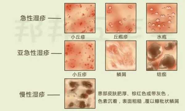 孕期外阴湿疹怎么办(阴部湿疹要如何治疗) 第3张 孕期外阴湿疹怎么办(阴部湿疹要如何治疗) 第3张