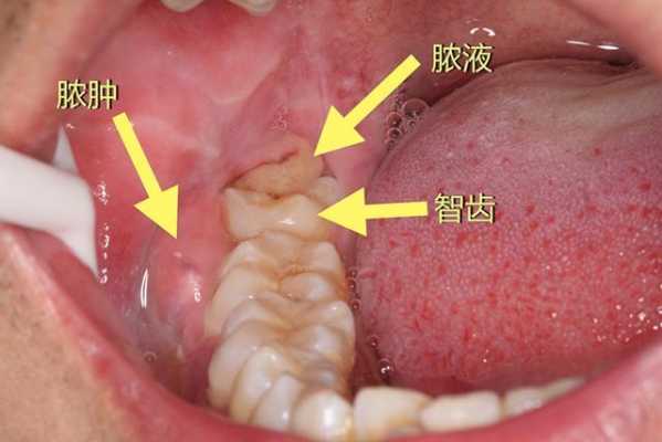 怀孕期间可以拔智齿吗（怀孕长智齿怎么办）  第1张