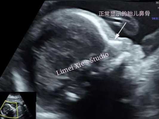 宝宝在肚子里喜欢趴着睡觉怎么办,胎儿趴着睡觉b超图 第2张 宝宝在肚子里喜欢趴着睡觉怎么办,胎儿趴着睡觉b超图 第2张