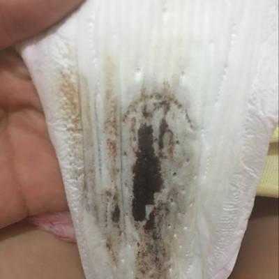 孕期鲜血(怀孕出血褐色变鲜红怎么办呀?这是不是严重了,胎儿还能保住吗) 第1张 孕期鲜血(怀孕出血褐色变鲜红怎么办呀?这是不是严重了,胎儿还能保住吗) 第1张