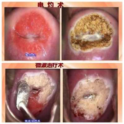 孕期宫颈糜烂会出血吗（孕期宫颈糜烂会出血吗怎么办）  第2张