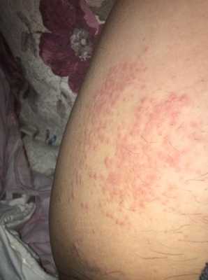 孕妇腿上起红疙瘩还很痒要怎么办,孕期大腿痒是怎么回事 第2张 孕妇腿上起红疙瘩还很痒要怎么办,孕期大腿痒是怎么回事 第2张