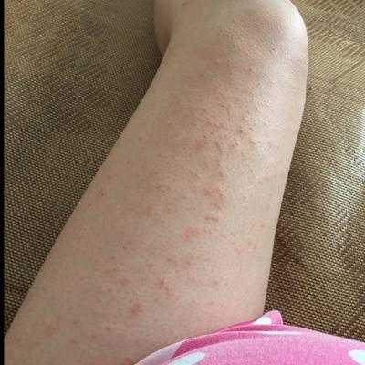 孕妇腿上起红疙瘩还很痒要怎么办,孕期大腿痒是怎么回事 第1张 孕妇腿上起红疙瘩还很痒要怎么办,孕期大腿痒是怎么回事 第1张