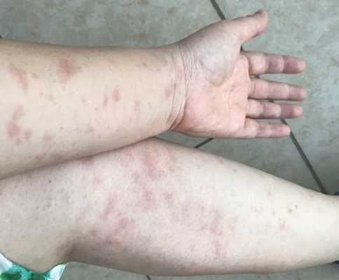 备孕期间吃了过敏药,对怀孕有影响吗,备孕期间过敏了怎么办呢 第2张 备孕期间吃了过敏药,对怀孕有影响吗,备孕期间过敏了怎么办呢 第2张