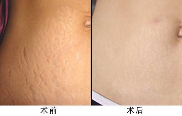 孕期4个月长了妊娠纹怎么办,孕期长妊娠纹了怎么办呢 第1张 孕期4个月长了妊娠纹怎么办,孕期长妊娠纹了怎么办呢 第1张