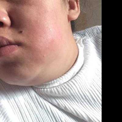 谁知道牙疼脸肿了要几天消肿呀,孕期脸肿了正常的吗 第1张 谁知道牙疼脸肿了要几天消肿呀,孕期脸肿了正常的吗 第1张