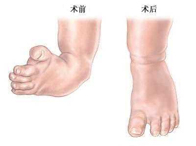 胎儿双足内翻图片(胎儿双足内翻图片大全) 第2张 胎儿双足内翻图片(胎儿双足内翻图片大全) 第2张