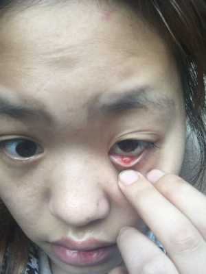 孕期眼睛肿(孕妇眼睛上长了个麦粒肿,这是上火的原因吗) 第2张 孕期眼睛肿(孕妇眼睛上长了个麦粒肿,这是上火的原因吗) 第2张