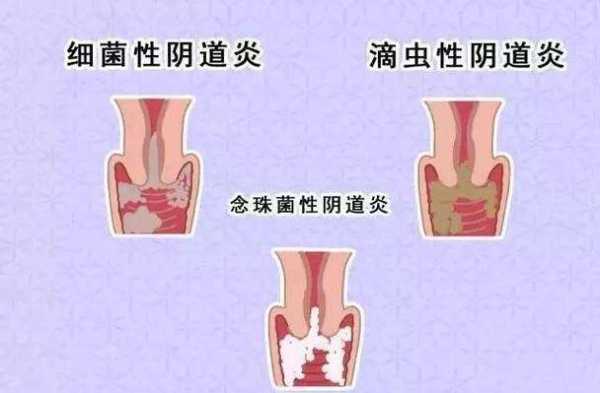 霉菌阴炎对胎儿的影响,  第2张