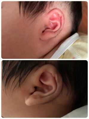 胎儿耳廓(胎儿耳廓形态异常难道就是畸形吗) 第1张 胎儿耳廓(胎儿耳廓形态异常难道就是畸形吗) 第1张
