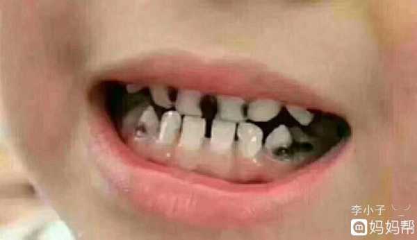 孕期牙齿变黑怎么回事（孕期牙齿变黑怎么回事儿）  第1张