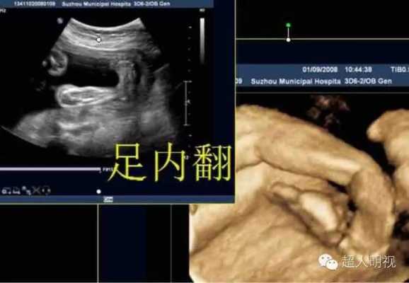 胎儿足内翻怎么回事,胎儿足周是多少周  第1张