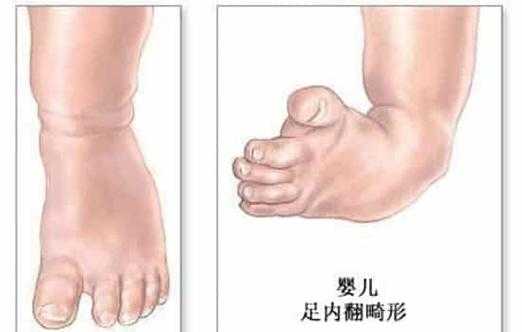 胎儿足内翻怎么回事,胎儿足周是多少周  第2张