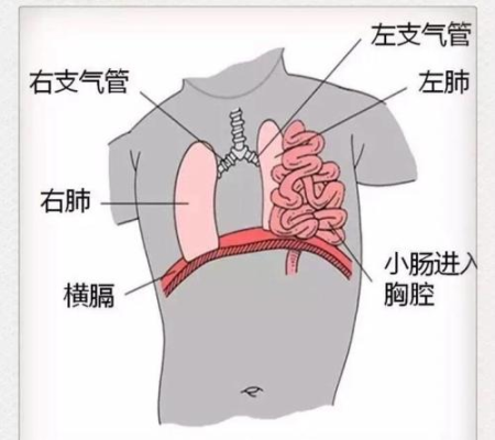 生理性中肠疝是什么疾病,膈疝胎儿存活率有多少 第2张 生理性中肠疝是什么疾病,膈疝胎儿存活率有多少 第2张