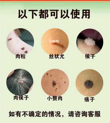 治疗孕期疣(孕七个月胸上长类似扁平疣的东西怎么办) 第2张 治疗孕期疣(孕七个月胸上长类似扁平疣的东西怎么办) 第2张