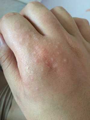 手指痒怎么办,孕期手指痒挠后有小水泡怎么回事 第2张 手指痒怎么办,孕期手指痒挠后有小水泡怎么回事 第2张