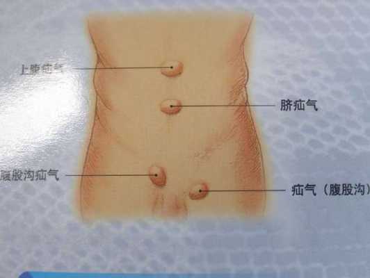 小孩疝气怎么治,胎儿肠疝是什么意思 第1张 小孩疝气怎么治,胎儿肠疝是什么意思 第1张
