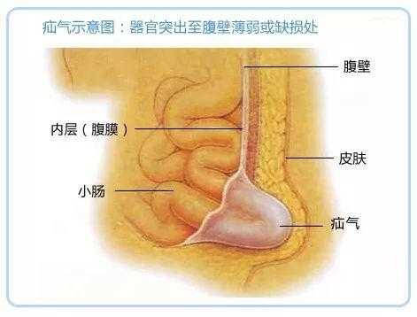 小孩疝气怎么治,胎儿肠疝是什么意思 第3张 小孩疝气怎么治,胎儿肠疝是什么意思 第3张