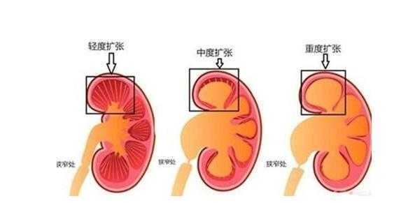 胎儿肾盂分离是什么意思,胎儿肾离合分离 第2张 胎儿肾盂分离是什么意思,胎儿肾离合分离 第2张