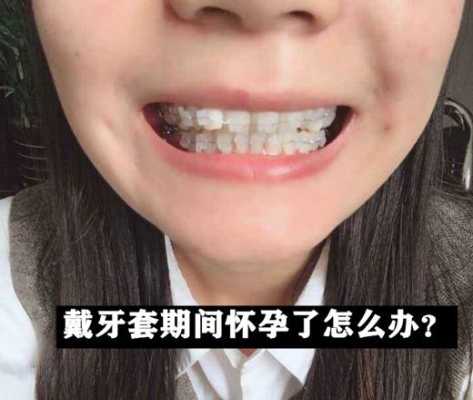 怀孕期间可以戴牙套吗(怀孕期间可以戴牙套吗) 第2张 怀孕期间可以戴牙套吗(怀孕期间可以戴牙套吗) 第2张