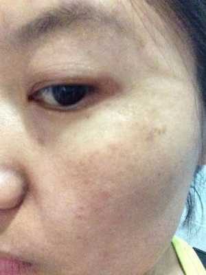 脸上孕斑怎么去除,孕期妊娠斑生完会掉吗 第2张 脸上孕斑怎么去除,孕期妊娠斑生完会掉吗 第2张