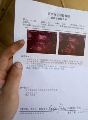 孕妇有肾结石怎么办,怀孕肾结石对胎儿有影响吗 第2张 孕妇有肾结石怎么办,怀孕肾结石对胎儿有影响吗 第2张