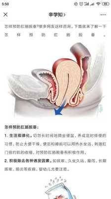 孕妇便秘脱肛怎么办,孕期肛脱怎么办 第2张 孕妇便秘脱肛怎么办,孕期肛脱怎么办 第2张