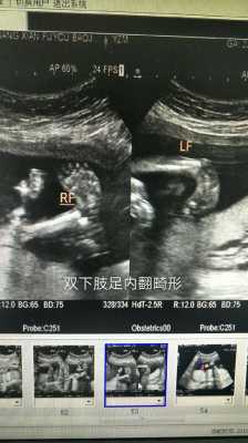 胎儿双足(胎儿双足) 第1张 胎儿双足(胎儿双足) 第1张